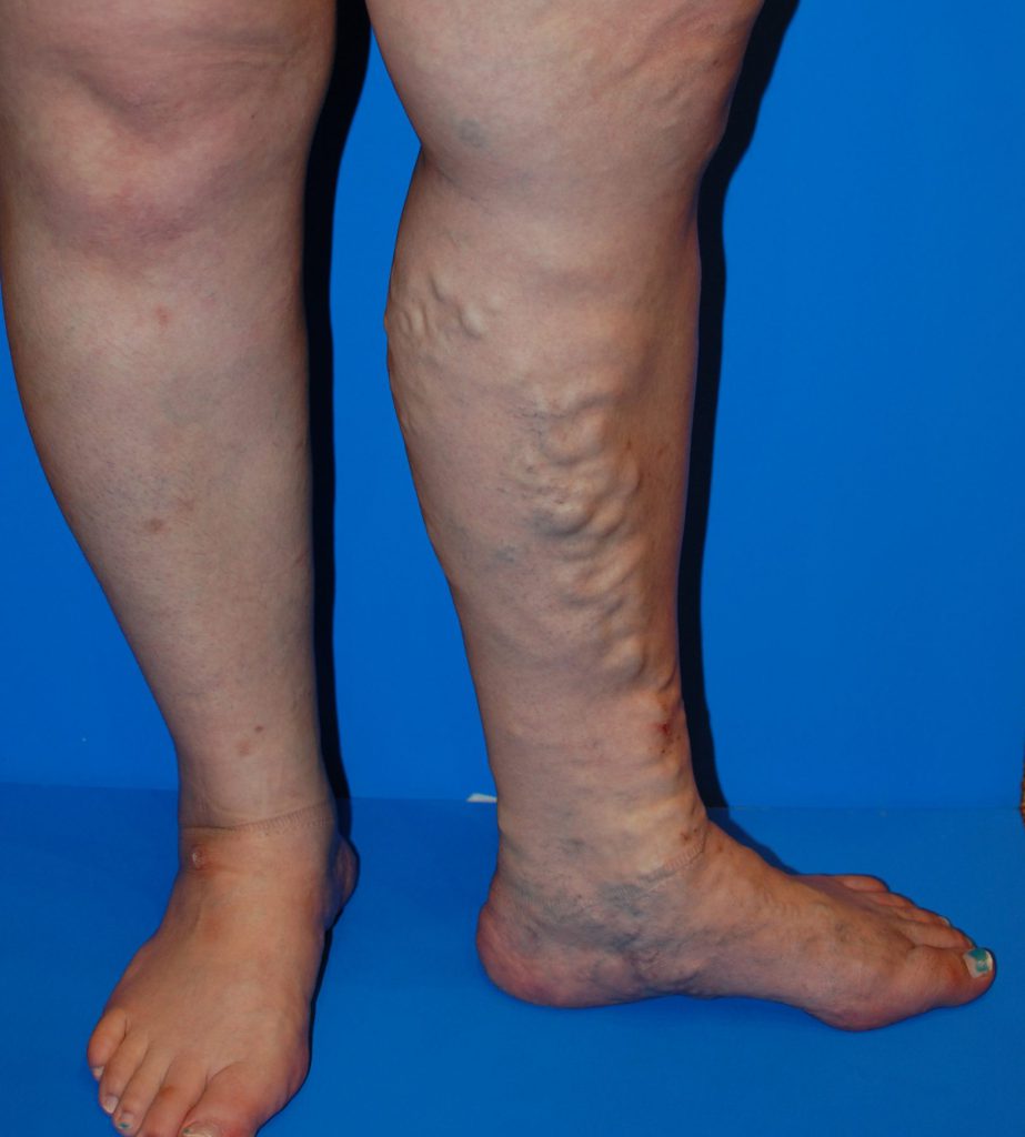 クネクネした足の血管がボコボコ浮き出てきたら何かの病気？