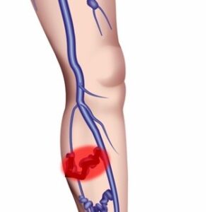 下肢静脈瘤と血栓性静脈炎：原因から治療まで詳しく解説