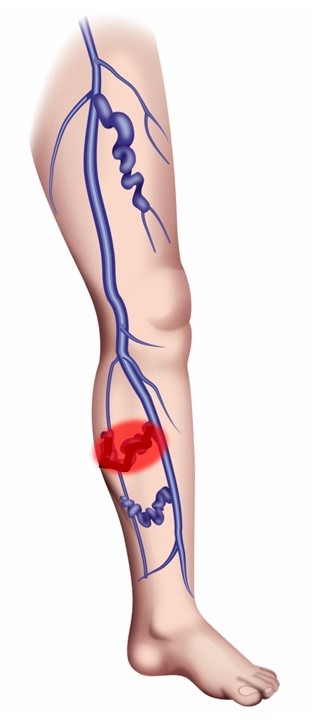 下肢静脈瘤と血栓性静脈炎：原因から治療まで詳しく解説