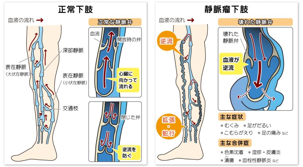 足の血管が浮き出る原因とは?下肢静脈瘤の可能性をチェック | 下肢静脈瘤の原因・症状・治療方法・予防方法などを専門医が解説