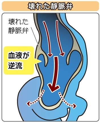 壊れた静脈弁