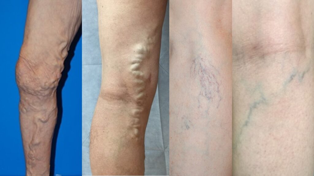 足の血管ボコボコ解消！写真で見る下肢静脈瘤の治療法と予防策