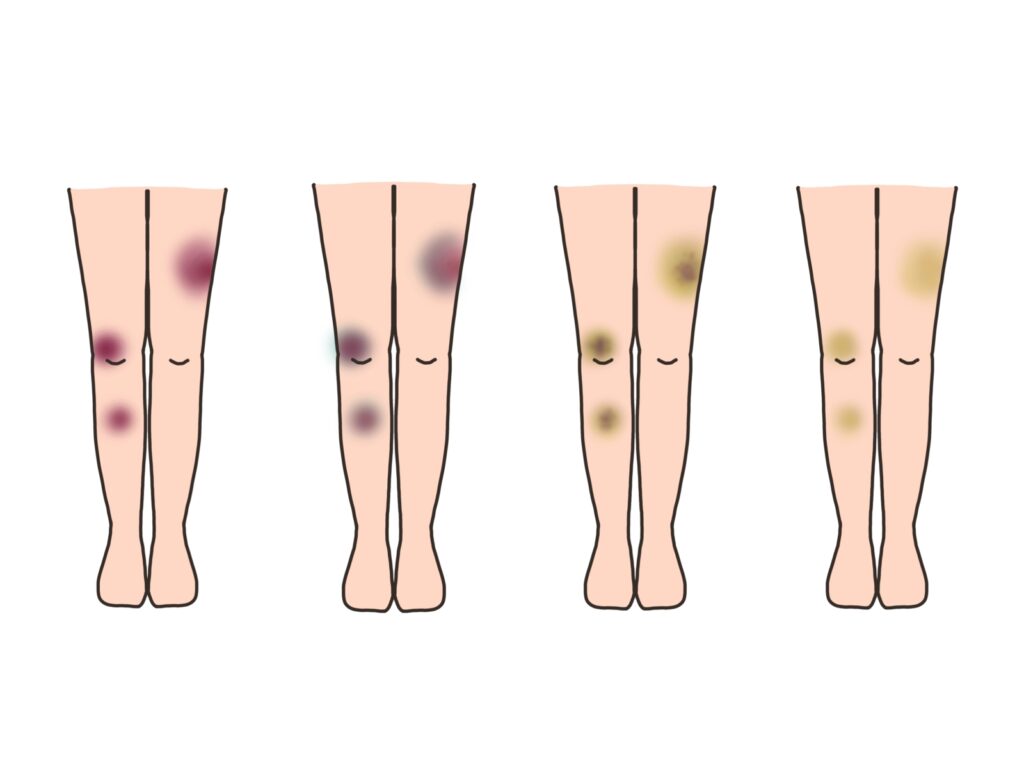 下肢静脈瘤レーザー手術後のあざと痛みについて