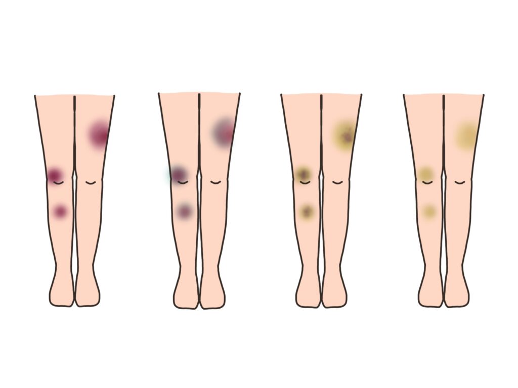 腱板手術後の神経損傷の症状