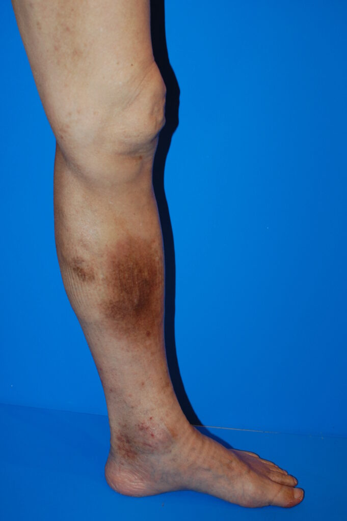 写真で見る症状と対策: 下肢静脈瘤とうっ滞性皮膚炎