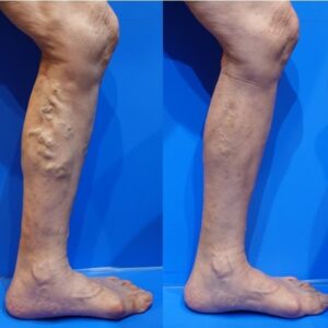 下肢静脈瘤の手術後、足の症状と見た目はどうなる？生活面での注意点は？
