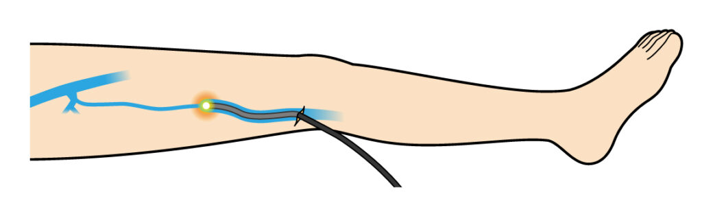下肢静脈瘤のレーザー治療：どのような人が適応になりますか？