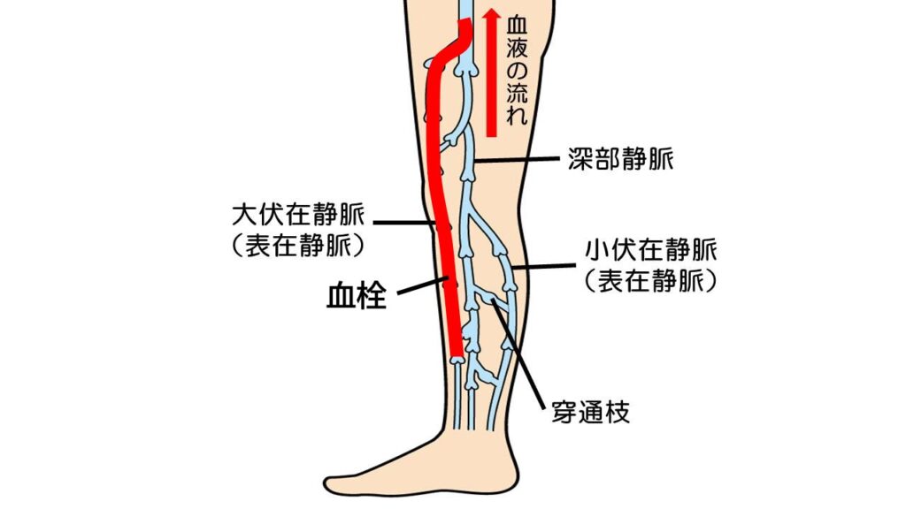 オペ後の深部静脈血栓症の予防 – 深部静脈血栓症 治し方 – 34-02医学雑誌_01_1住田先生.indd – LXVW