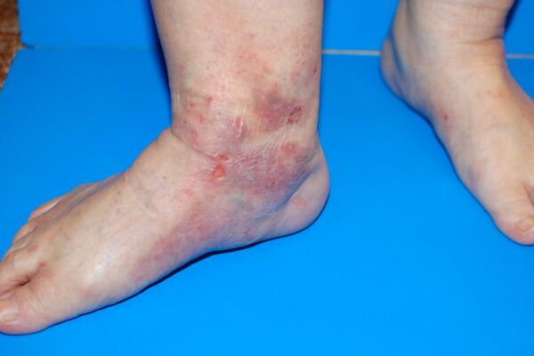 自宅で静脈瘤のかゆみを管理するにはどうすればよいですか?