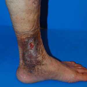 下肢静脈瘤の重症例：うっ滞性皮膚炎と皮膚潰瘍の治療