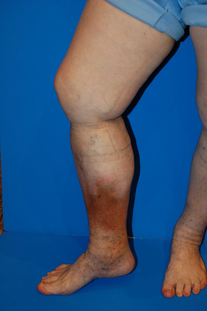 下肢静脈瘤と皮膚のかゆみには関係があるって本当！？