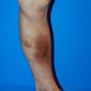 足の皮膚の黒ずみと下肢静脈瘤の関係性について