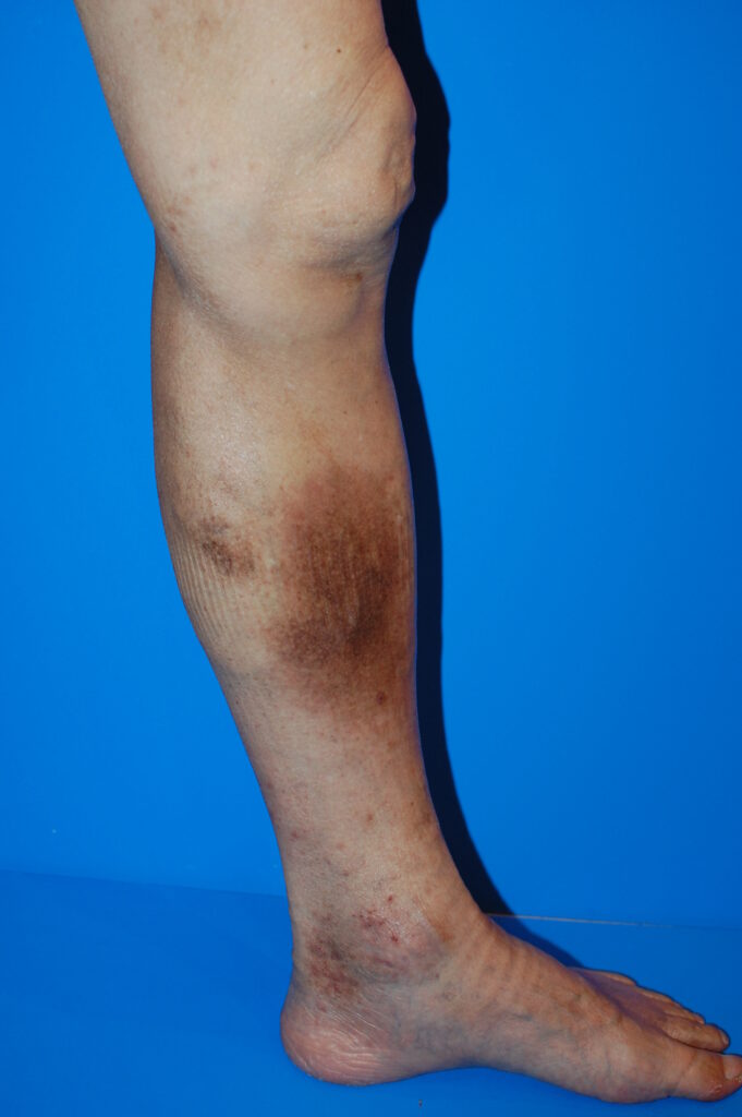 足の皮膚の黒ずみと下肢静脈瘤の関係性について