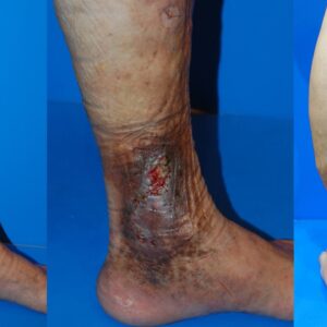 下肢静脈瘤の放置が引き起こす皮膚炎と対策