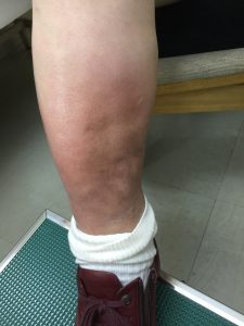 ｑ ａ 足の色素沈着は 静脈瘤を治療すれば治るの 目黒外科 東京都品川区 目黒駅から徒歩30秒