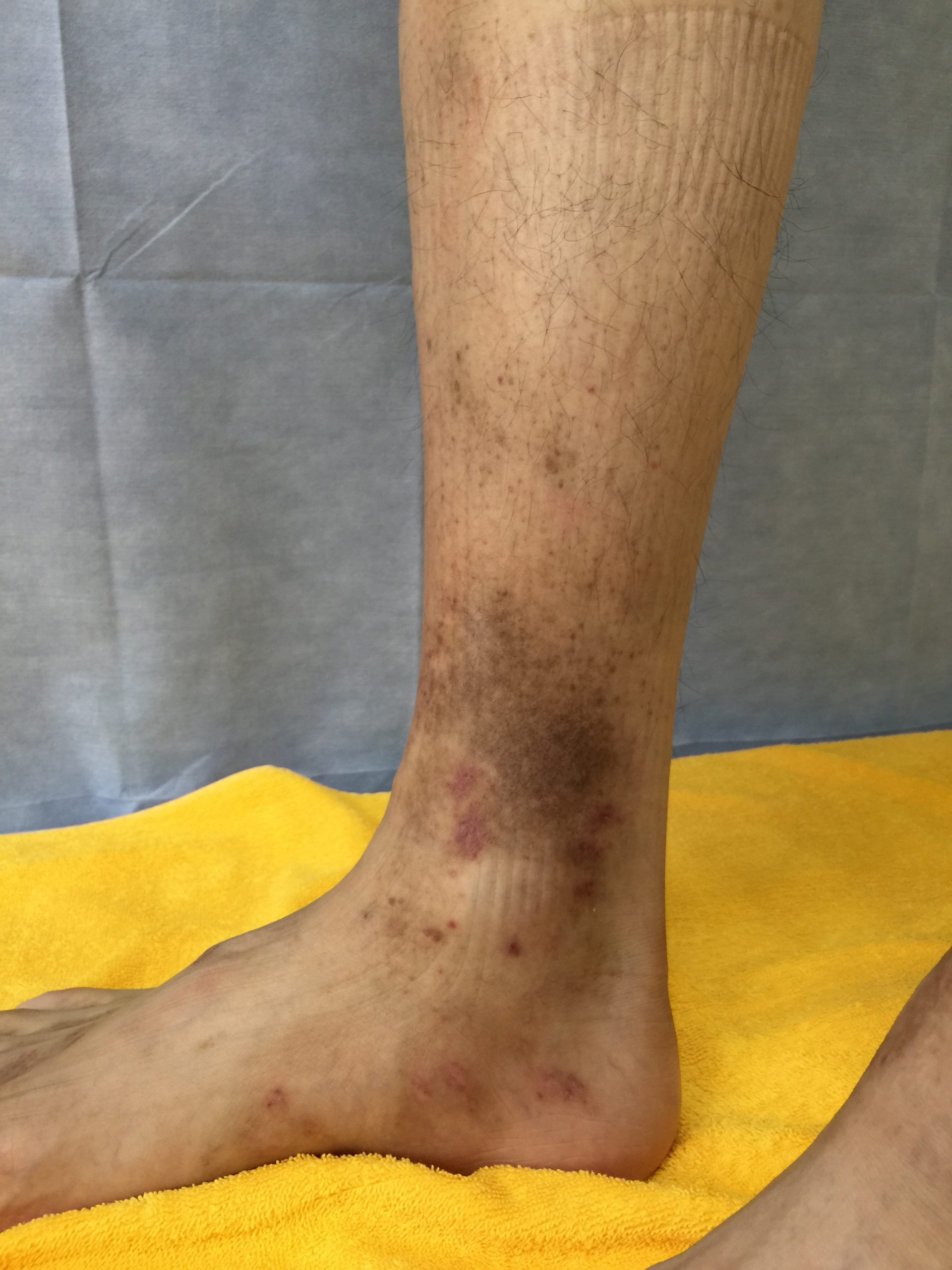 足 の 傷跡 皮膚 科