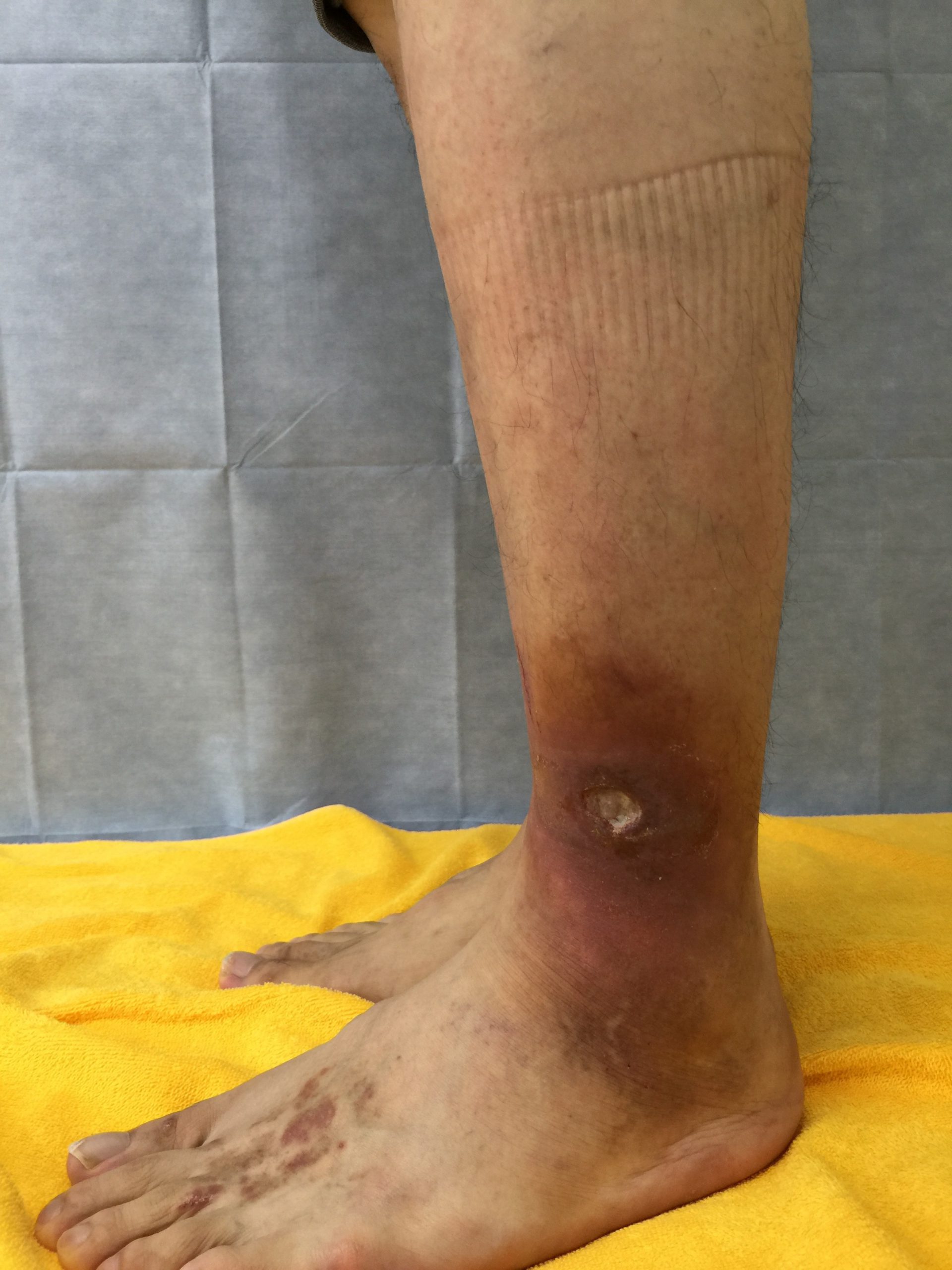 うっ滞性潰瘍の治療 目黒外科 東京都品川区 目黒駅から徒歩30秒