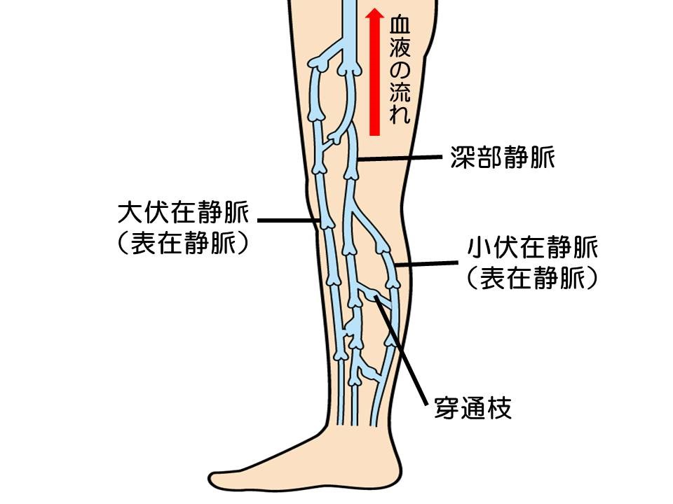 表在性血栓性静脈炎は予防できるのでしょうか?