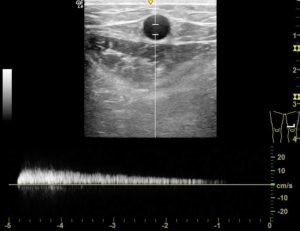 50代男性下肢静脈瘤の超音波検査