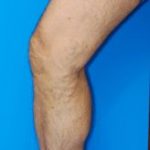 40代男性下肢静脈瘤事例