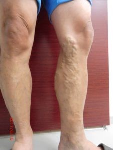 50代男性下肢静脈瘤の事例
