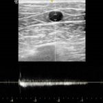 40代男性下肢静脈瘤超音波検査