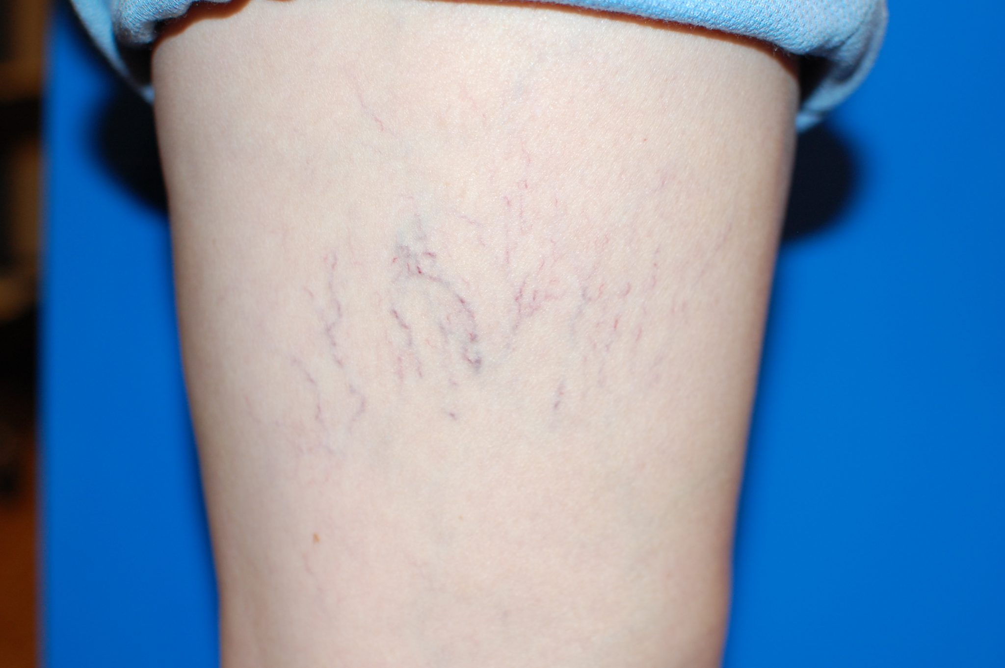 ポリドカノールフォームによる静脈瘤の治療を発見してください