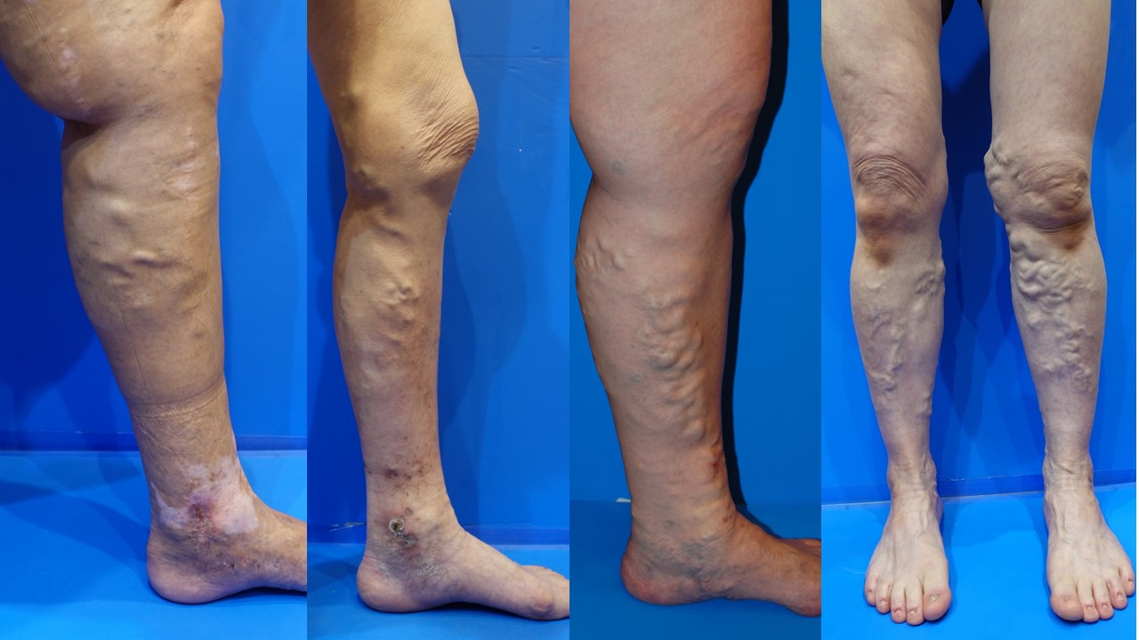 足の血管 クネクネ